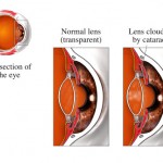 Cataract surgery